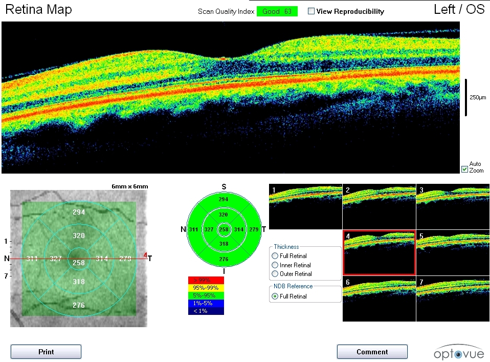 Octmaculardegeneration Rancho Santa Fe Optometry